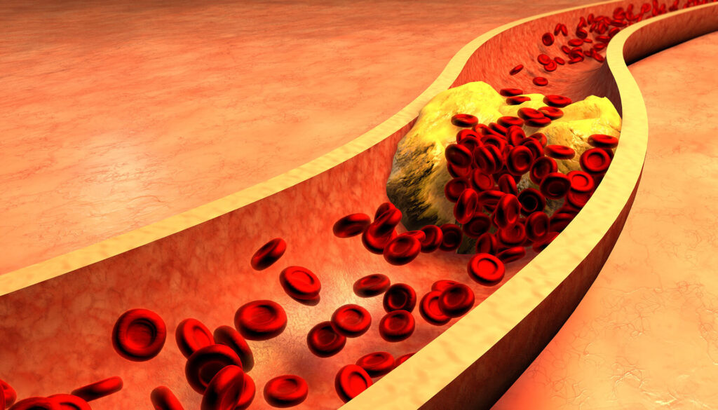 cholesterol LDL