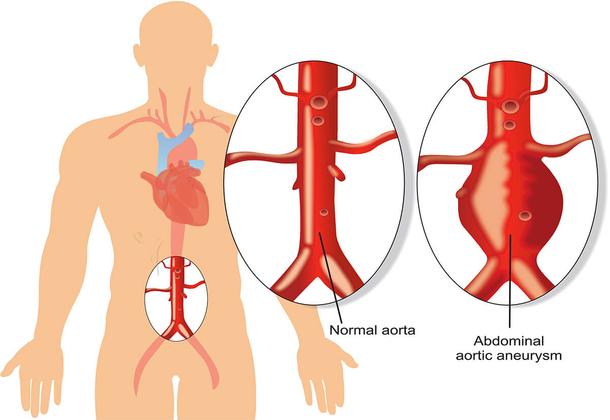 Ilustracja tętniak aorty