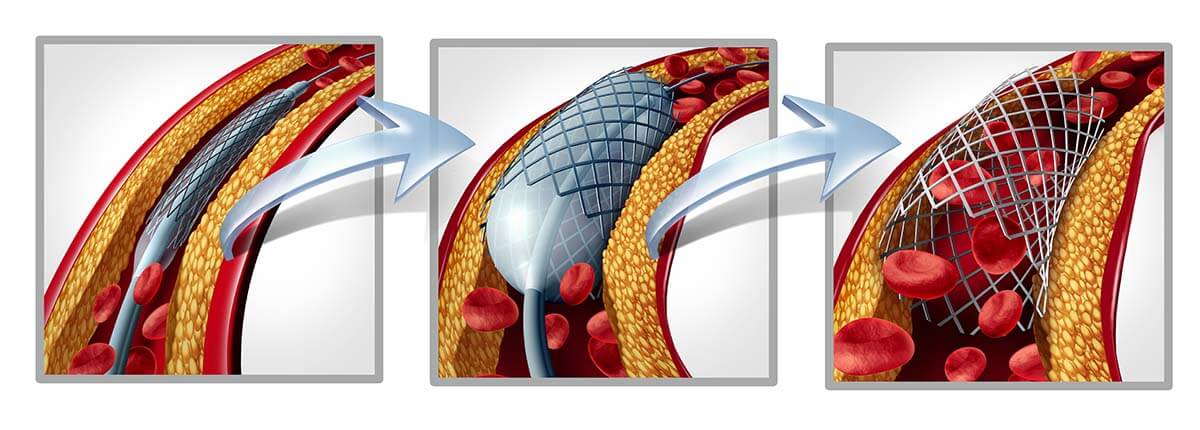 Angioplastyka wieńcowa