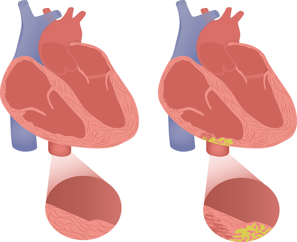 Arytmogenna kardiomiopatia prawokomorowa - ARVC